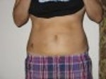 1 week after smart lipo - front